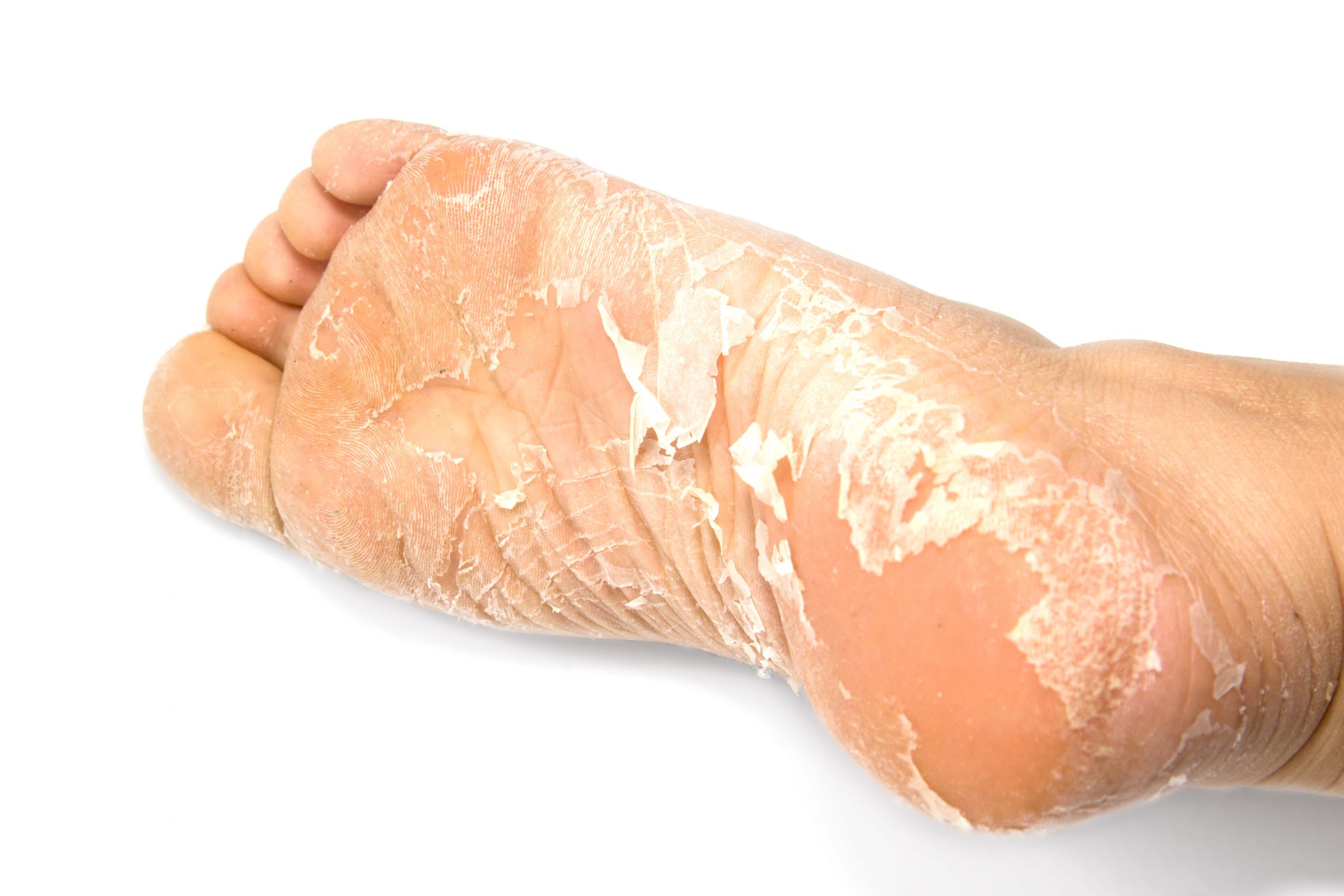Маска для отшелушивания ног - одна из масок для ног, которую могут приобрести клиенты BIOCROWN.